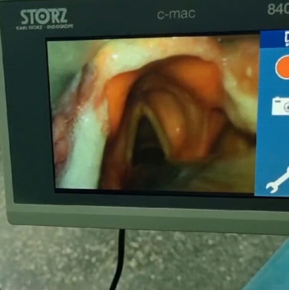Видеть, чтобы не рисковать: видеоассистированная интубация в челюстно-лицевой хирургии
